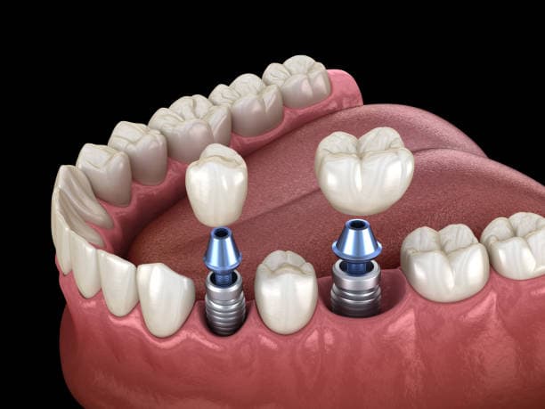 Dental implant placement surgery