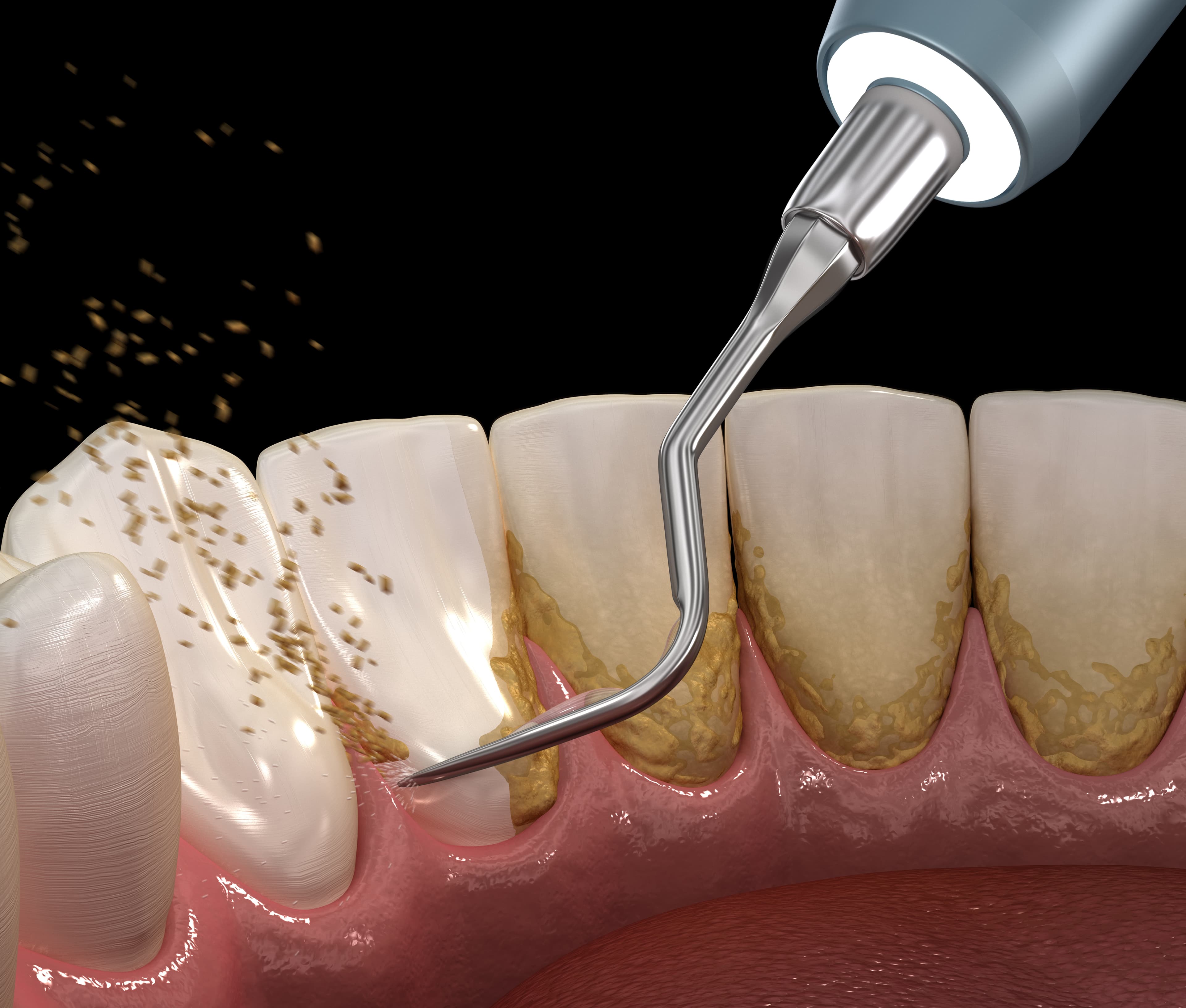 Plaque Removal