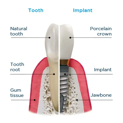 What Are Dental Implants? Image