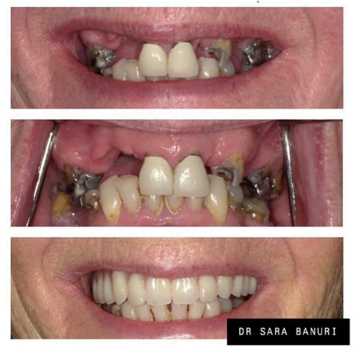 Final dental implant crown restoration
