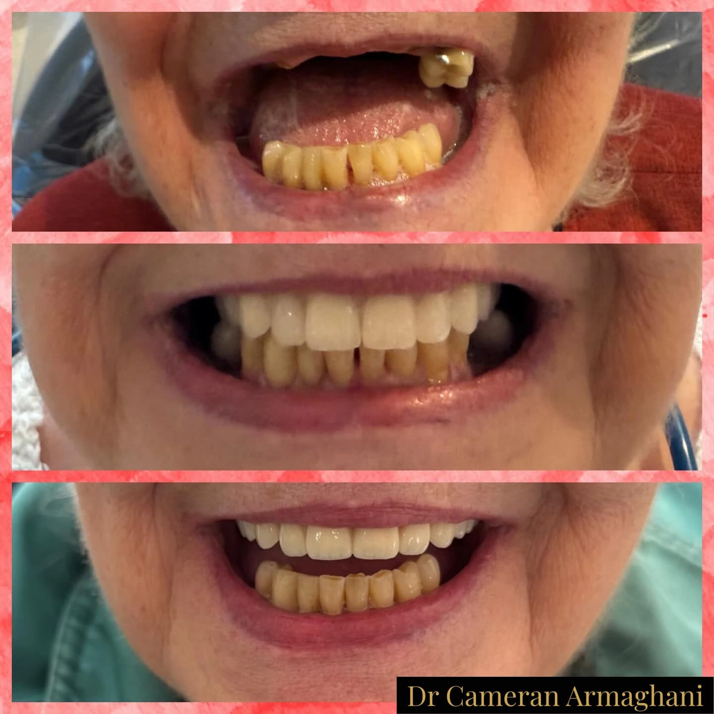 Final dental implant crown restoration