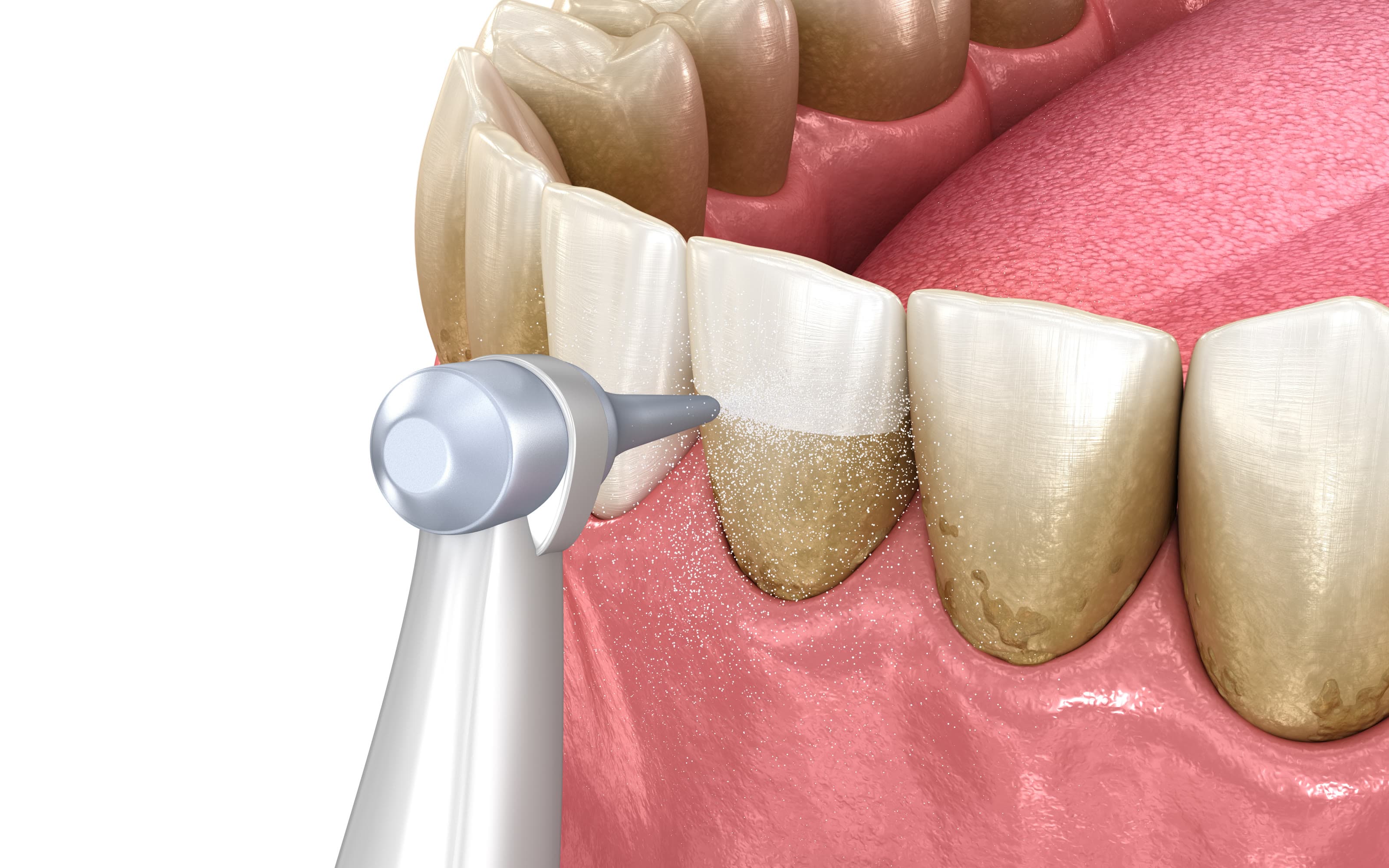 Airflow teeth polishing treatment
