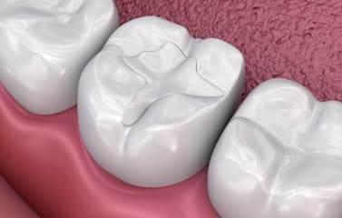 White composite dental filling treatment in Bridgwater