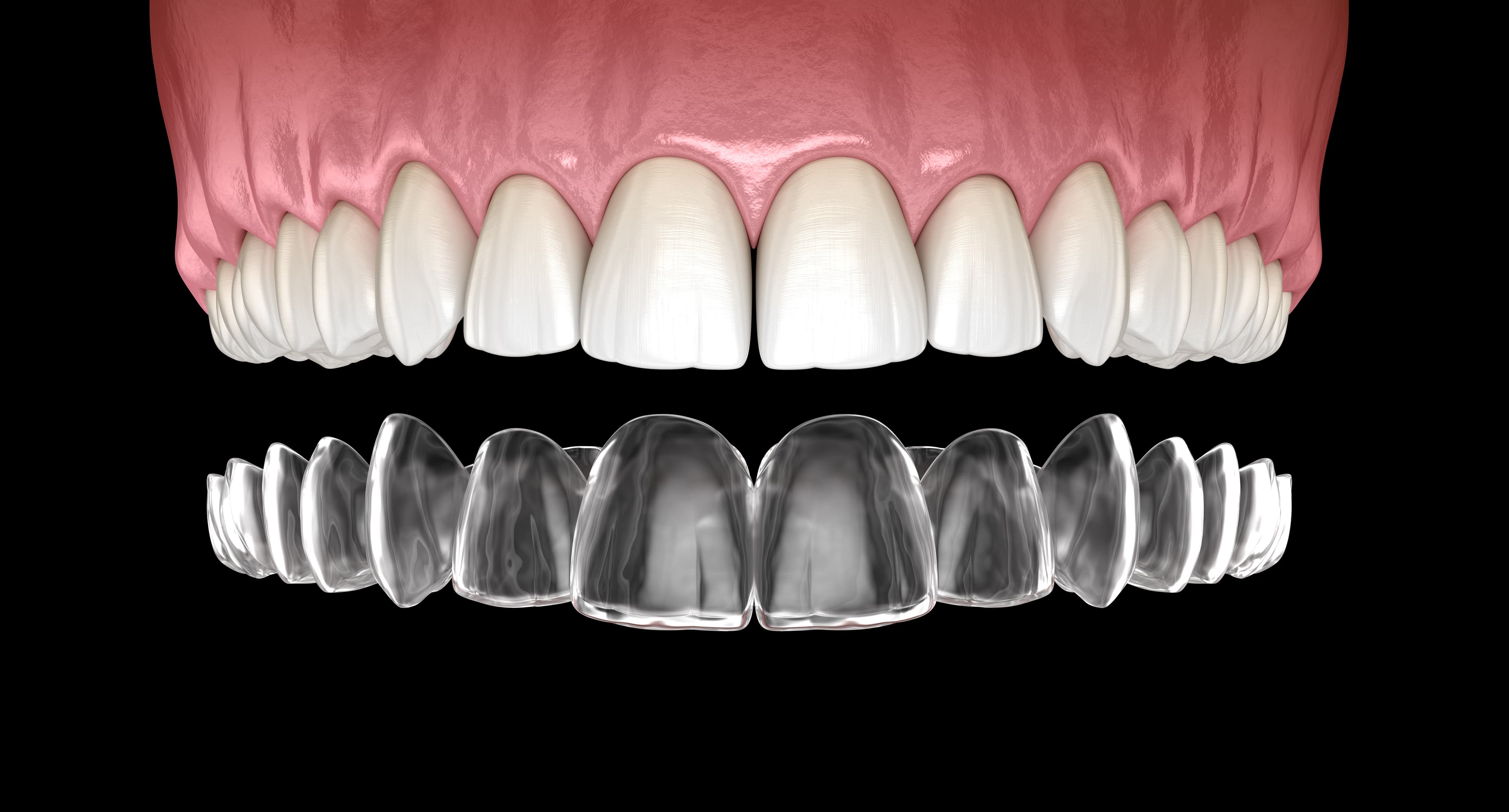 Invisalign clear aligners at Supernova Dental in Bridgwater