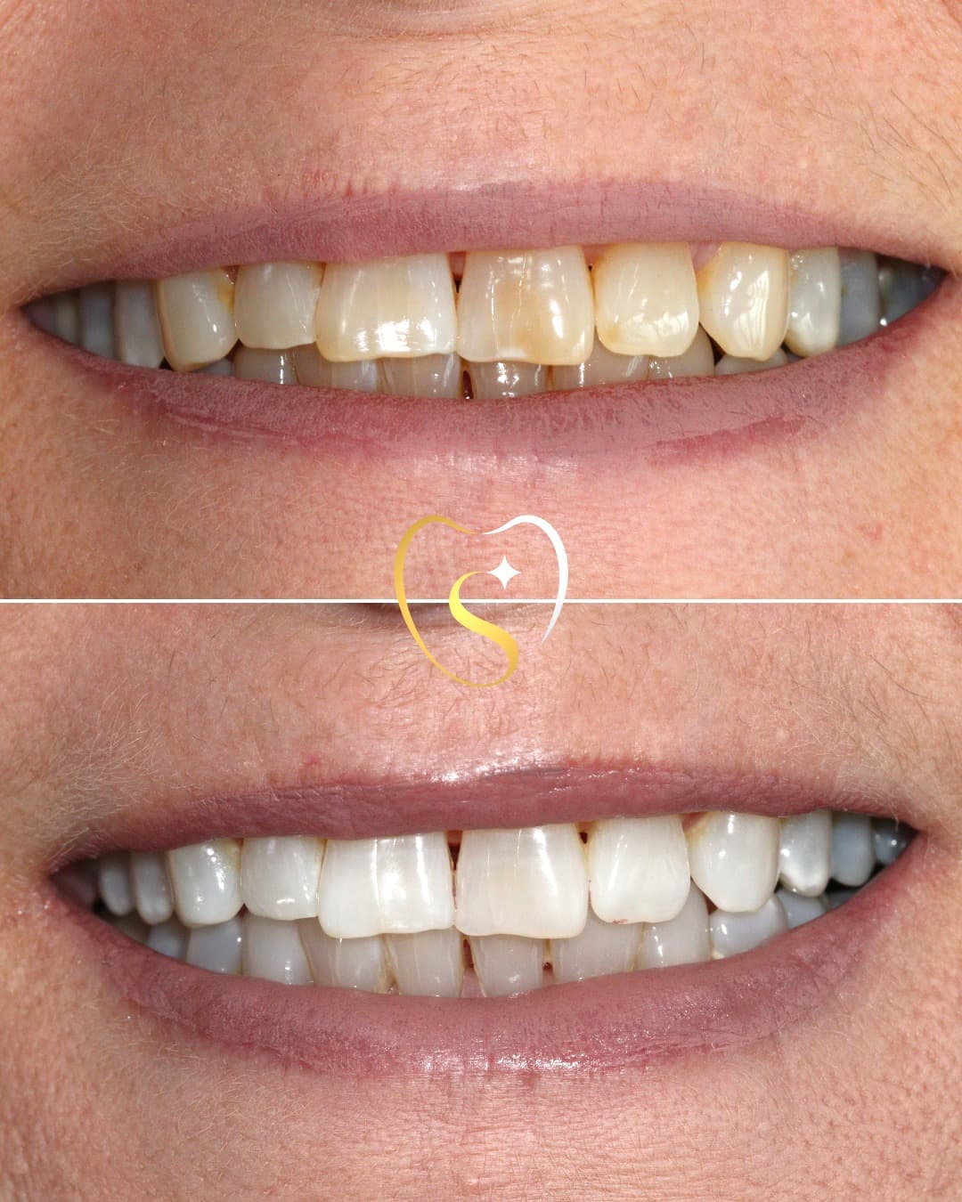 Professional teeth whitening treatment in Bridgwater